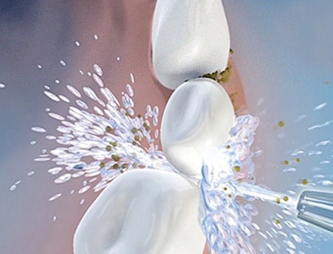 סילונית ניידת זרם מים סילון חזק שטיפה ניקוי חלל הפה מחיר לקניה בזול במבצע לוקו0ט שטיפה בלחץ מים