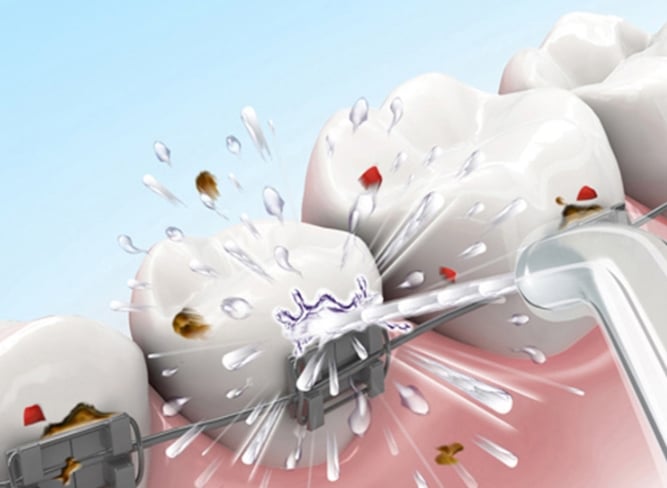 סילונית אלחוטית לחץ מים דלקות חניכיים עששת דנטלי מחיר לקניה בזול במבצע לוקו0ט גשר מתקן ליישור שיניים